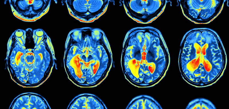 mri